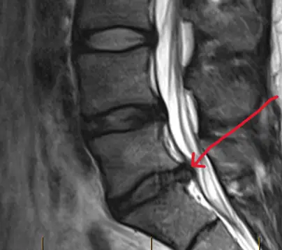 Herniated Disc Relief in Phoenix, AZ (Ahwatukee)